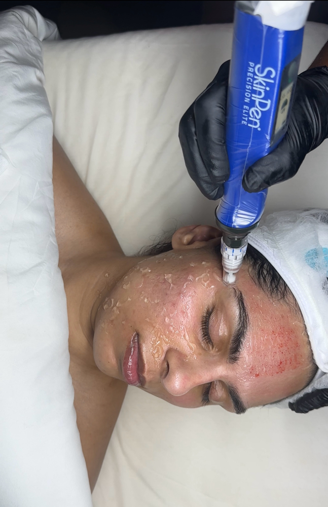 SkinPen Microneedling (Thighs)