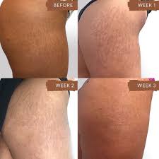 Stretch Mark Camouflage