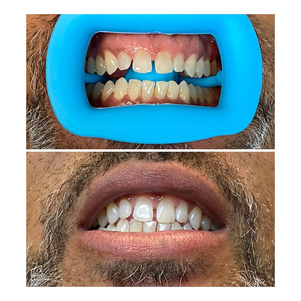 Express Teeth Whitening