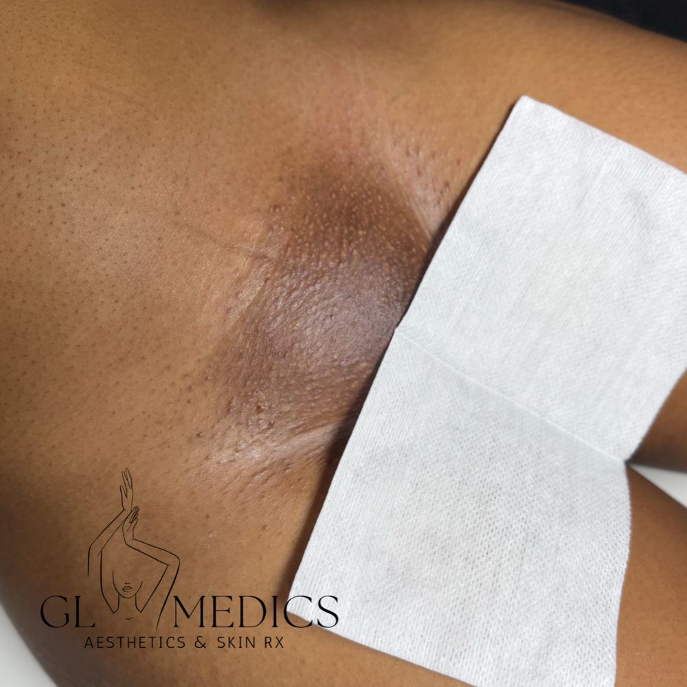 APRIL PROMO BRAZILIAN BARE at GlōMEDICS Aesthetics & Skin Rx in Houston, TX