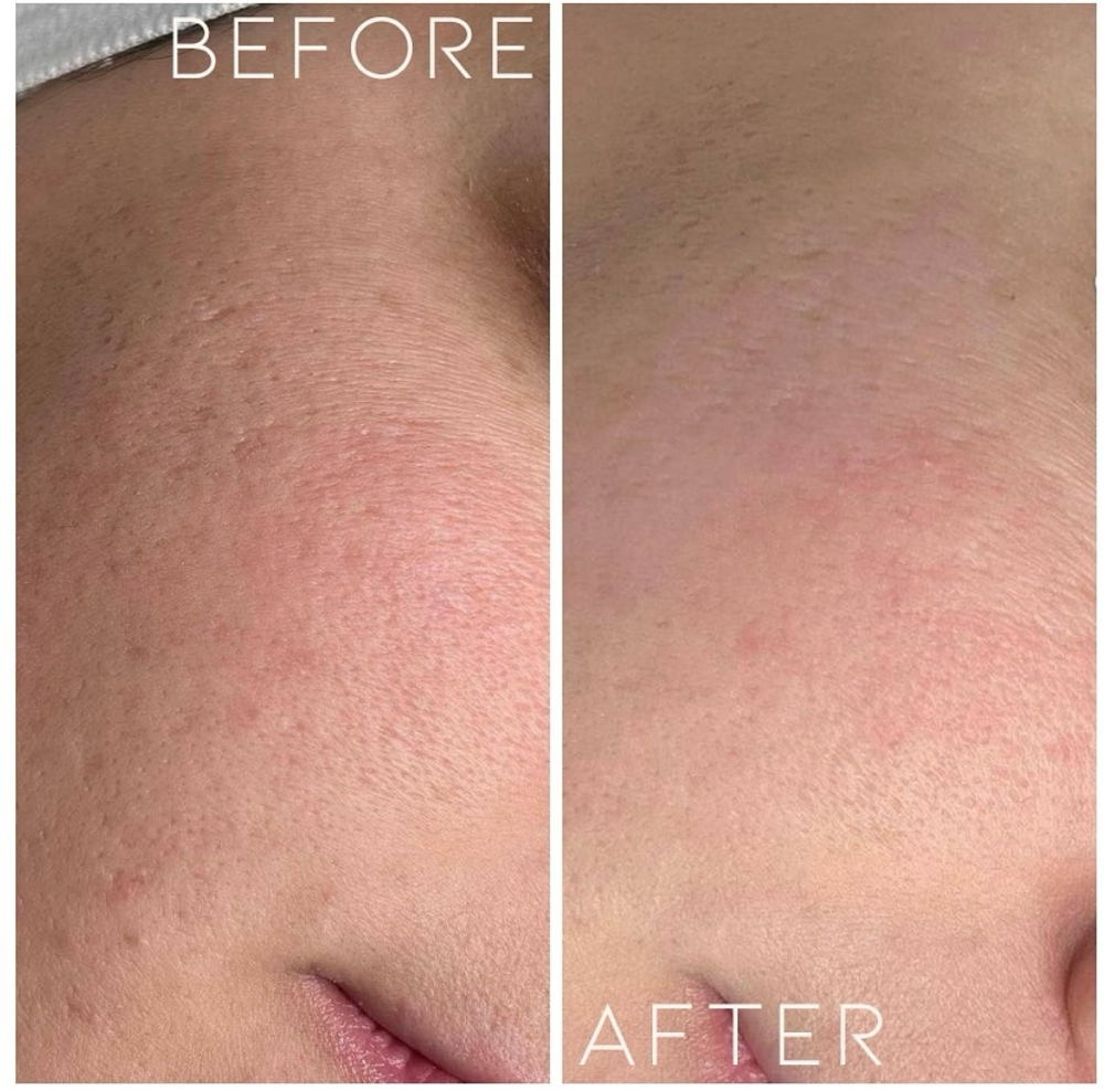 Liquid Microneedling