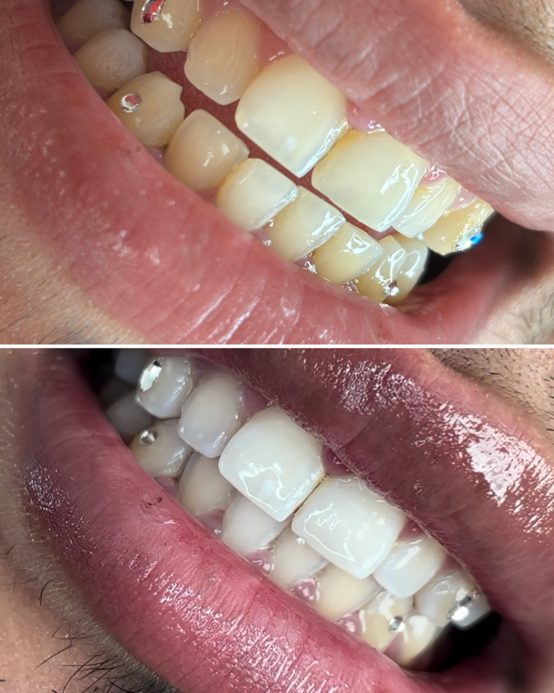 40 Minute Teeth Whitening