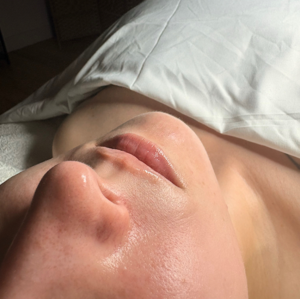 Lip Enhancment at Dream Skin in Kingston, NY