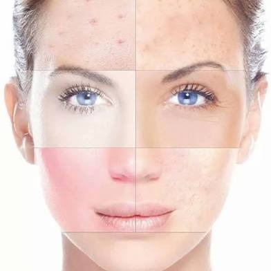 SkinPen Microneedling