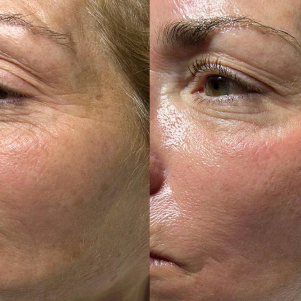 Hydrafacial at Skincare by Beth LLC in Winter Garden, FL
