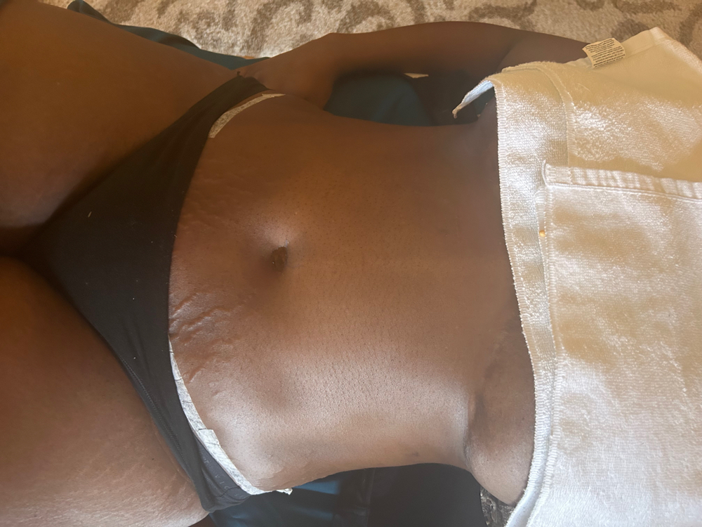 Lymphatic Drainage(Tummy Tuck/Lipo)