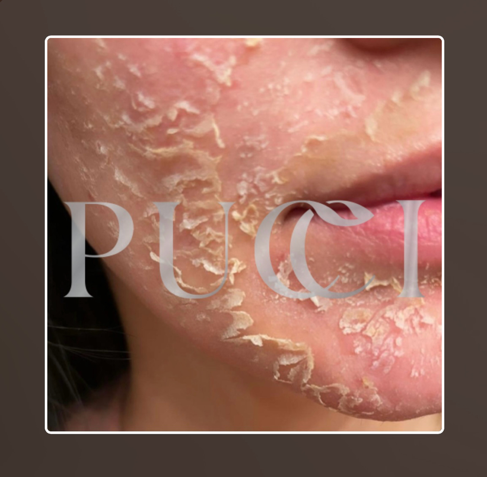 The Perfect Derma Peel