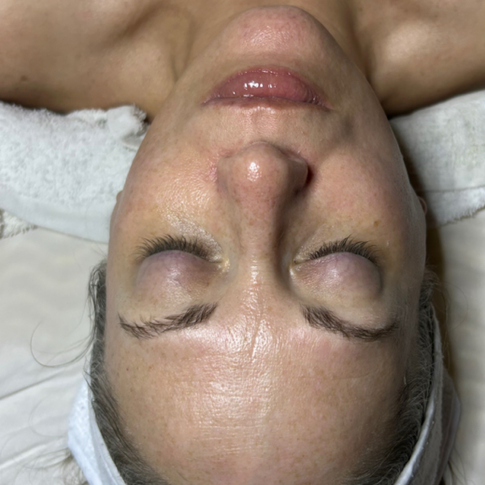 Chemical Peel And Dermaplane Plane at Peyton Bustamante in Harrisburg, IL