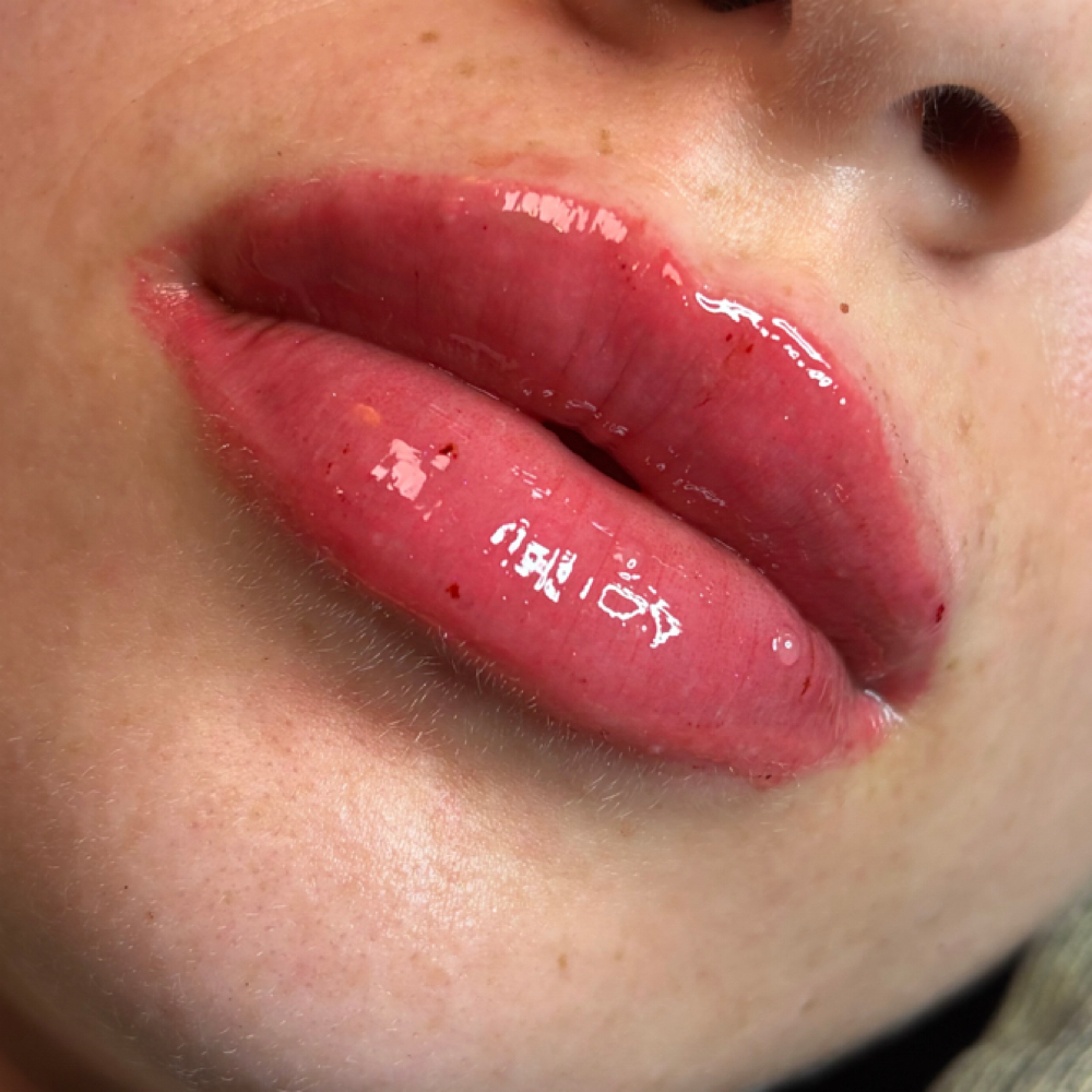 1ml Hybrid Needleless + microneedle at Glogetteresthetics in Warwick, RI