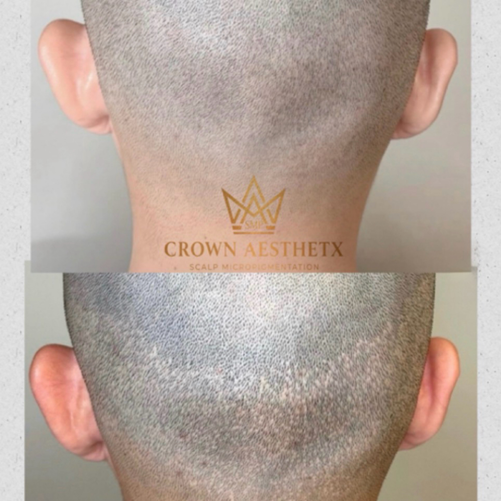 FUE Hair Transplant Scar Camouflage at Crown Aesthetx in Modesto, CA