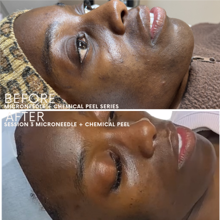 Microneedling + Peel Series at Glow Aesthetics Studio in Atlanta, GA