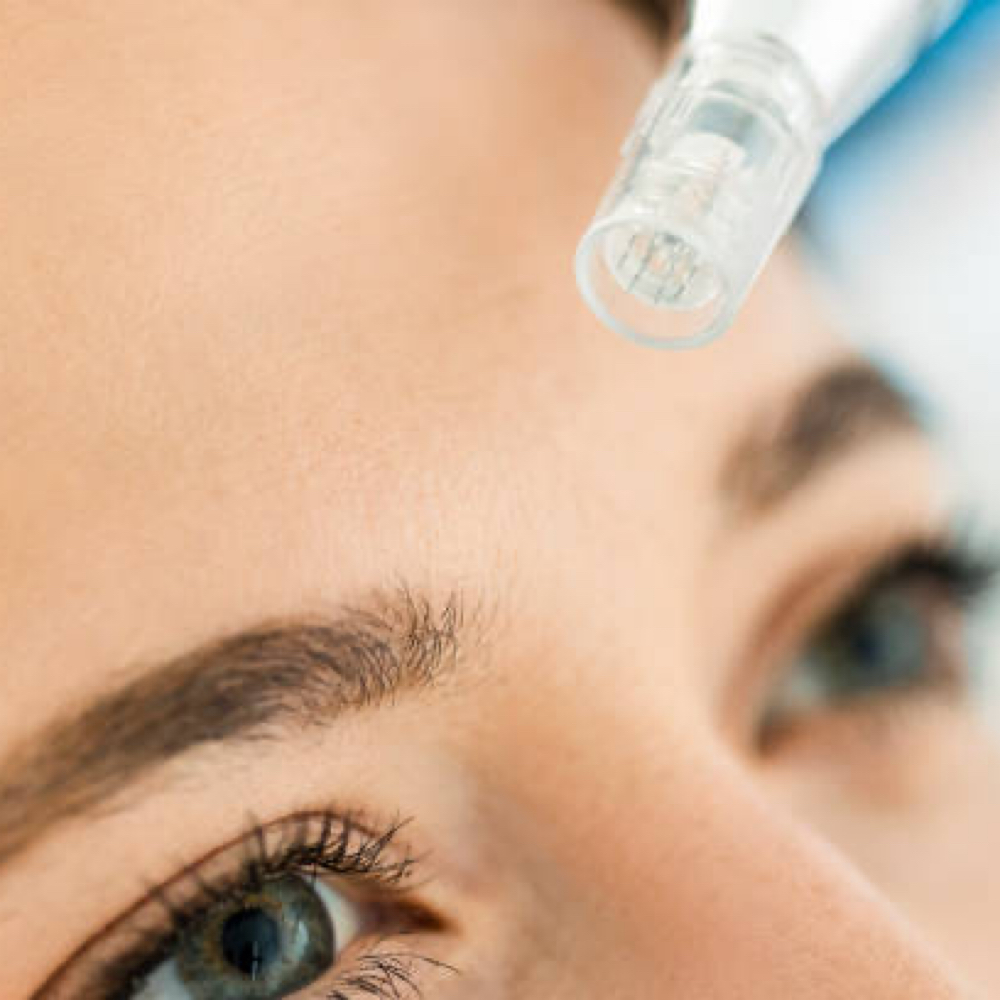 Microneedling at Cura Viso Aesthetics in West Chester, PA