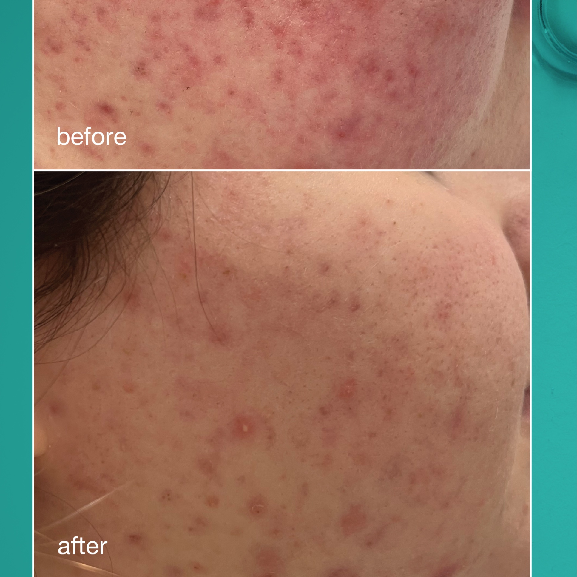 Clear Skin Acne Facial at Yes IIs Beauty in Chico, CA