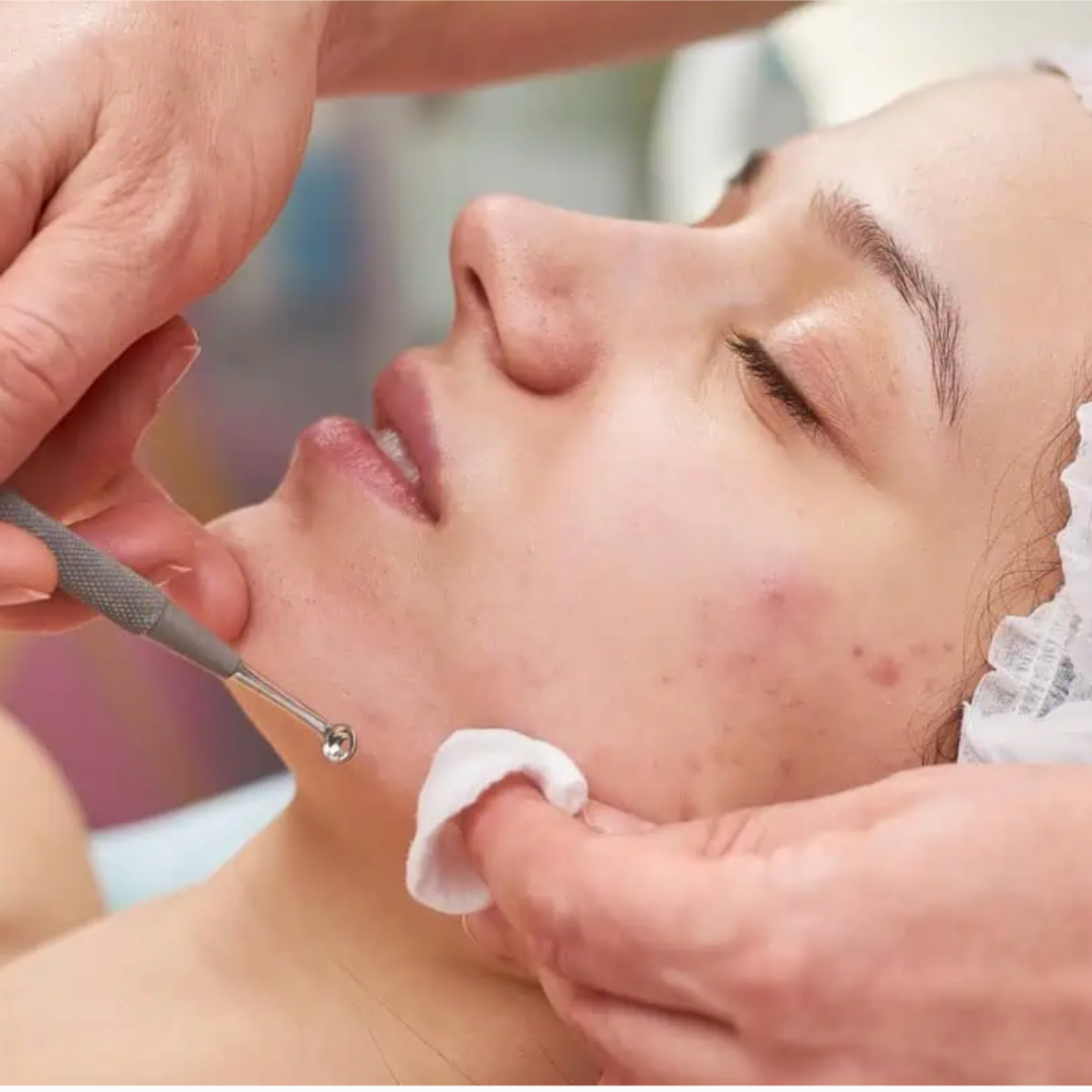 Acne Clarifying Extraction Facial at NUNÉ Esthetics in Fresno, CA