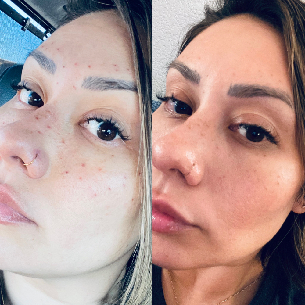 Faux Freckles - MicroShading