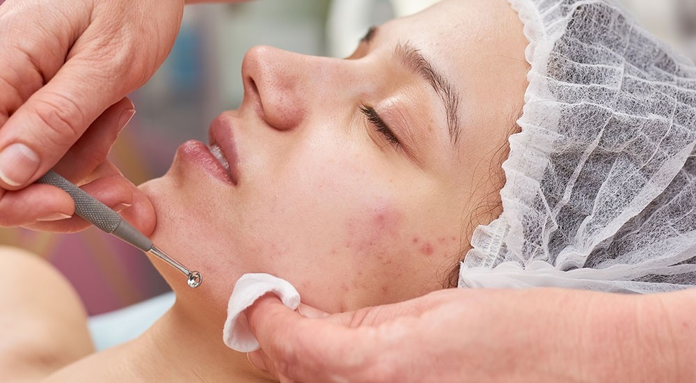 Acne Detox Facial