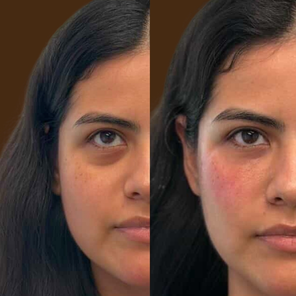 Undereye Filller at Aether Aesthetics in Midland, TX