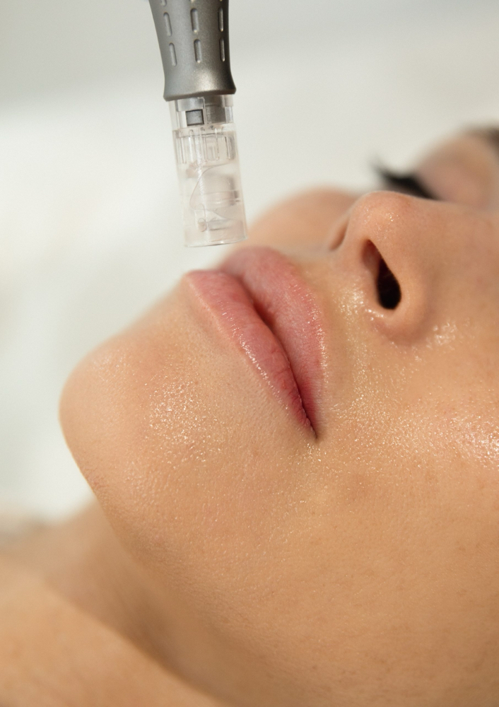 Microneedling
