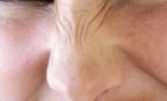 Bunny Lines at Lush MedSpa & IV Lounge in Middlesboro, KY