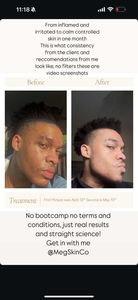 Acne Consultation
