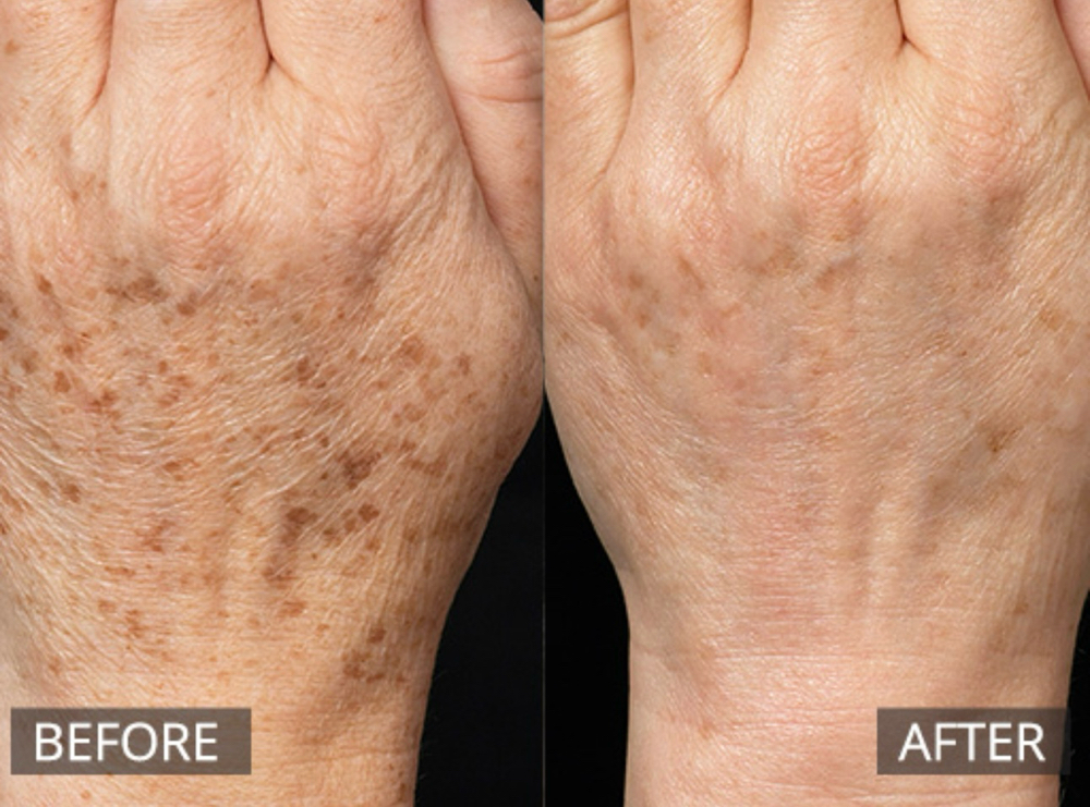 Hands Freckle Removal