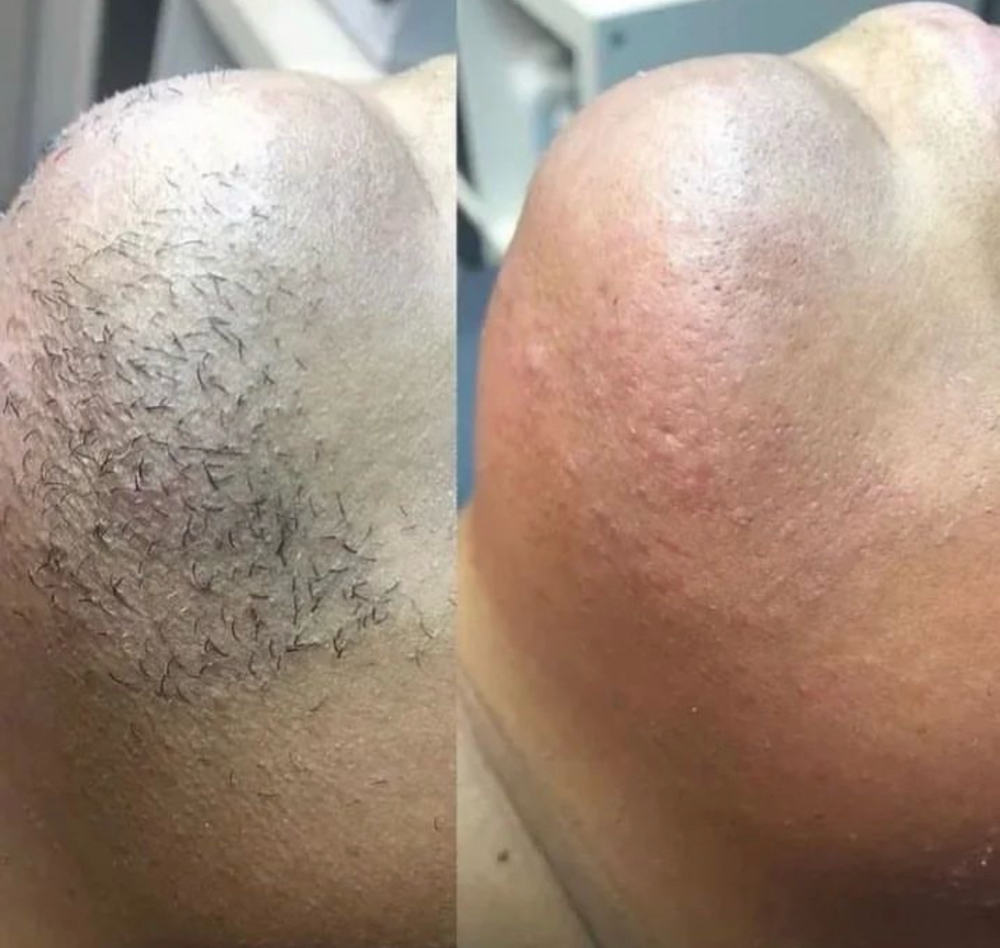 Chin Wax at Lè Glamour Bar in St. Thomas, VI