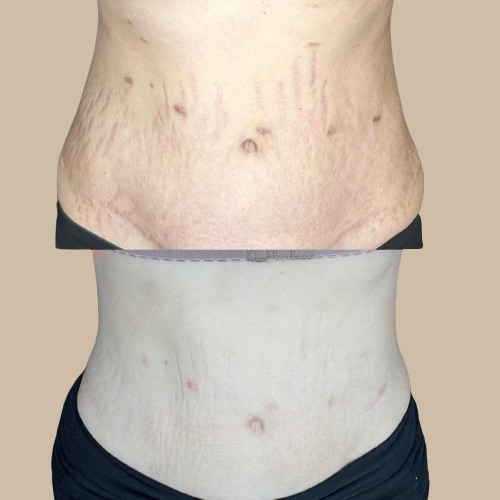Stretch Marks SMS Treatment