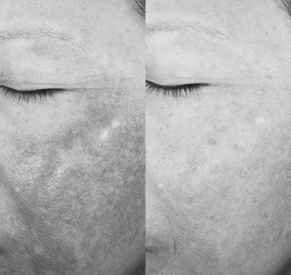 CUSTOM CHEMICAL PEEL