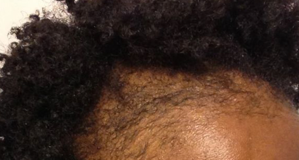 Hair Loss Topical Treatment at Mary Pugh in Farmville, VA