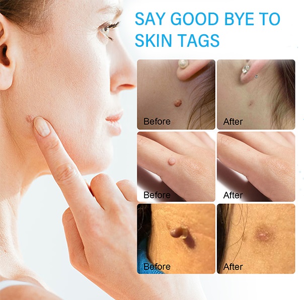Skin Tag remover