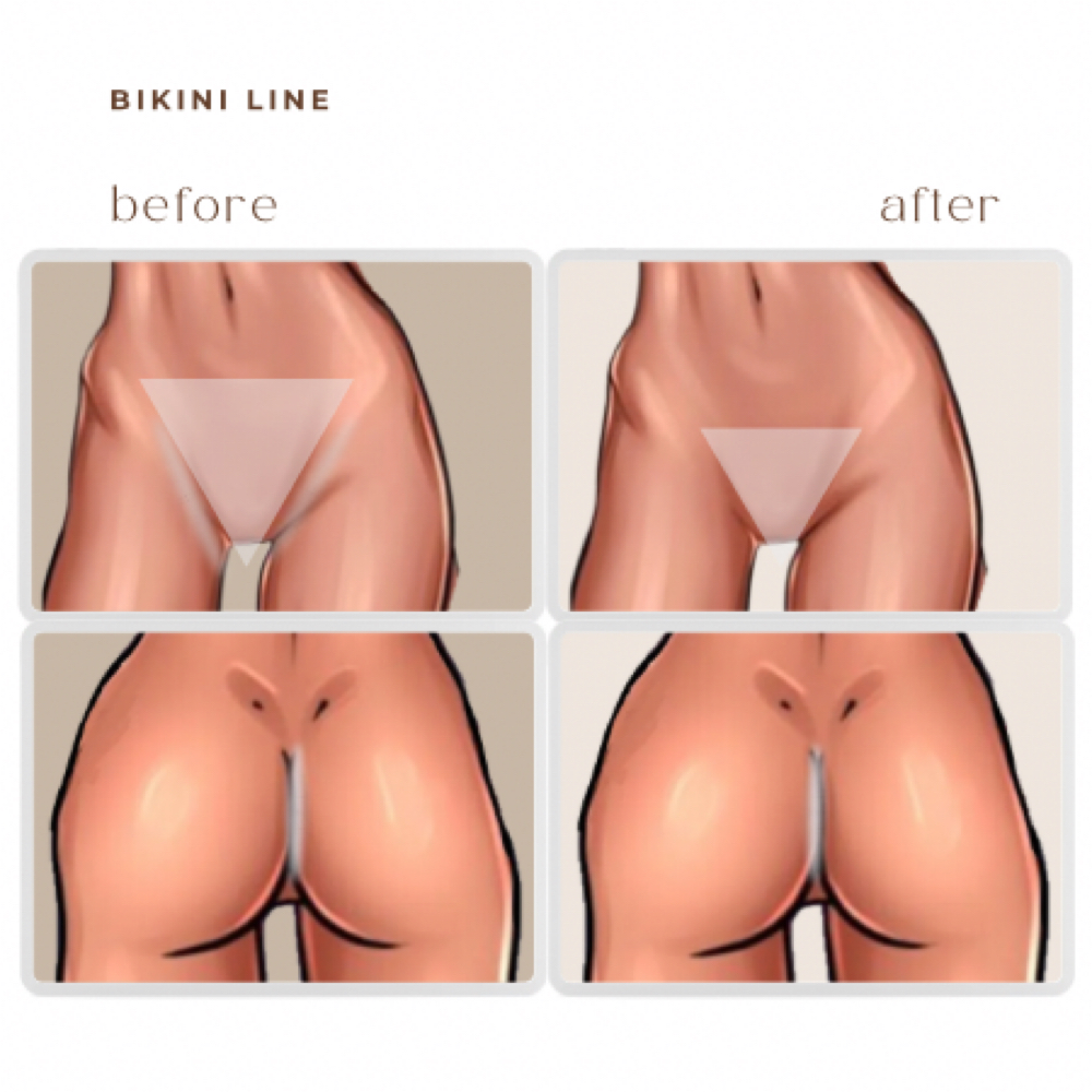 bikini line LASER HAIR REMOVAL at BEAUTY LAB COLLECTIVE in Miami, FL