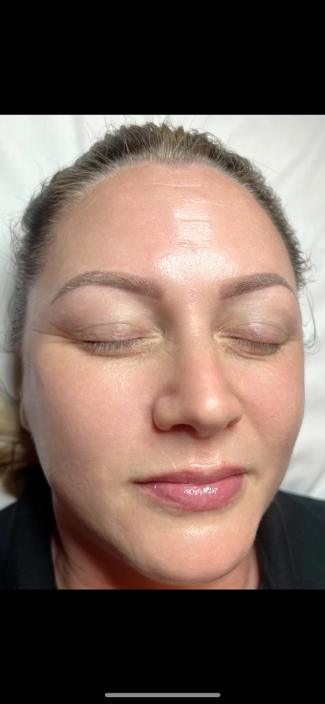 Chemical Peel