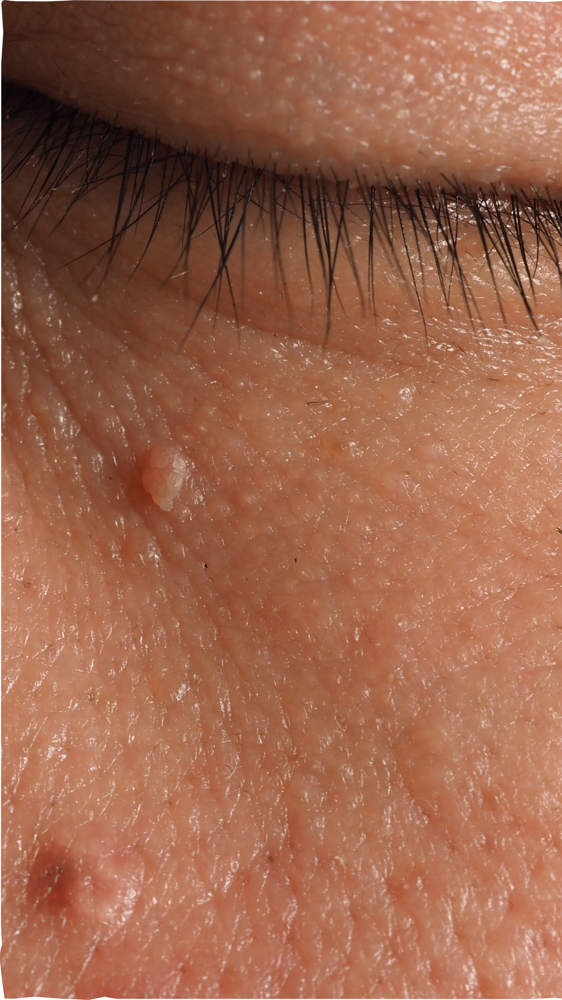 Skin Tag Removal