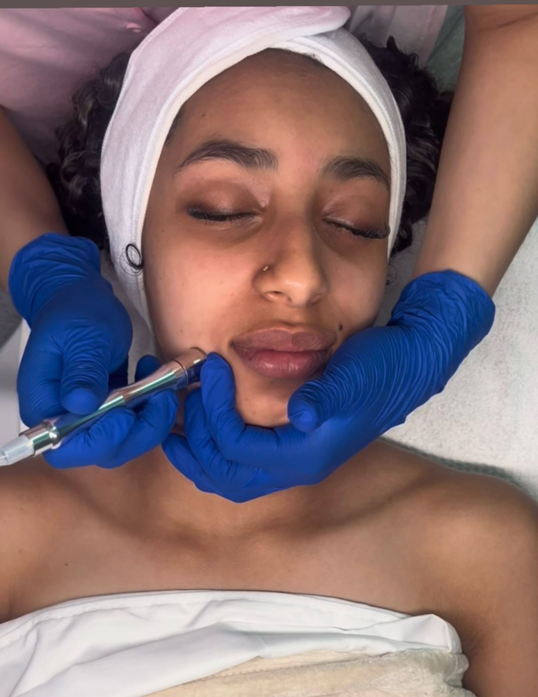 Microdermabrasion Facial