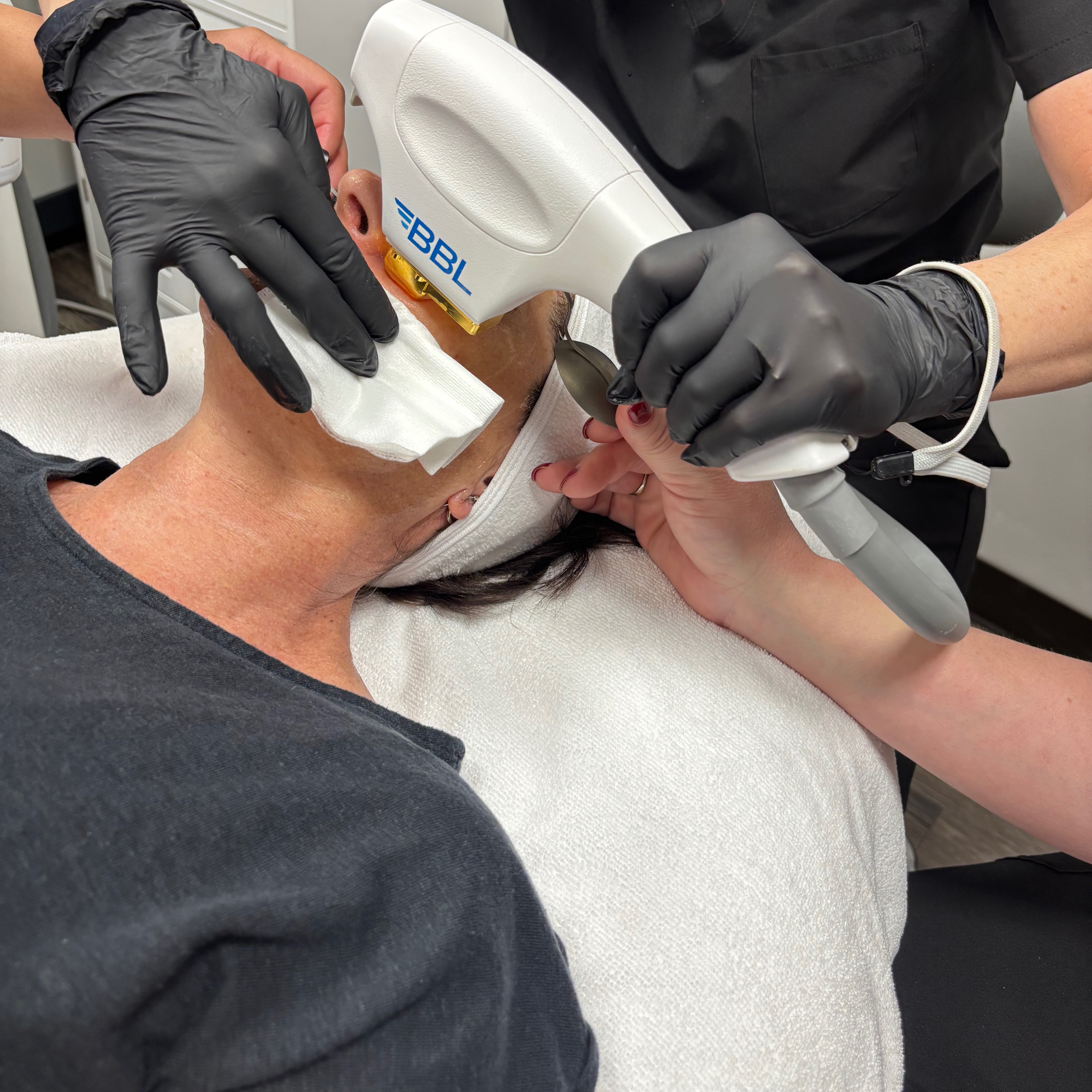 Sciton Laser Procedures at Timeless Beauty by Bridget in Peoria, AZ