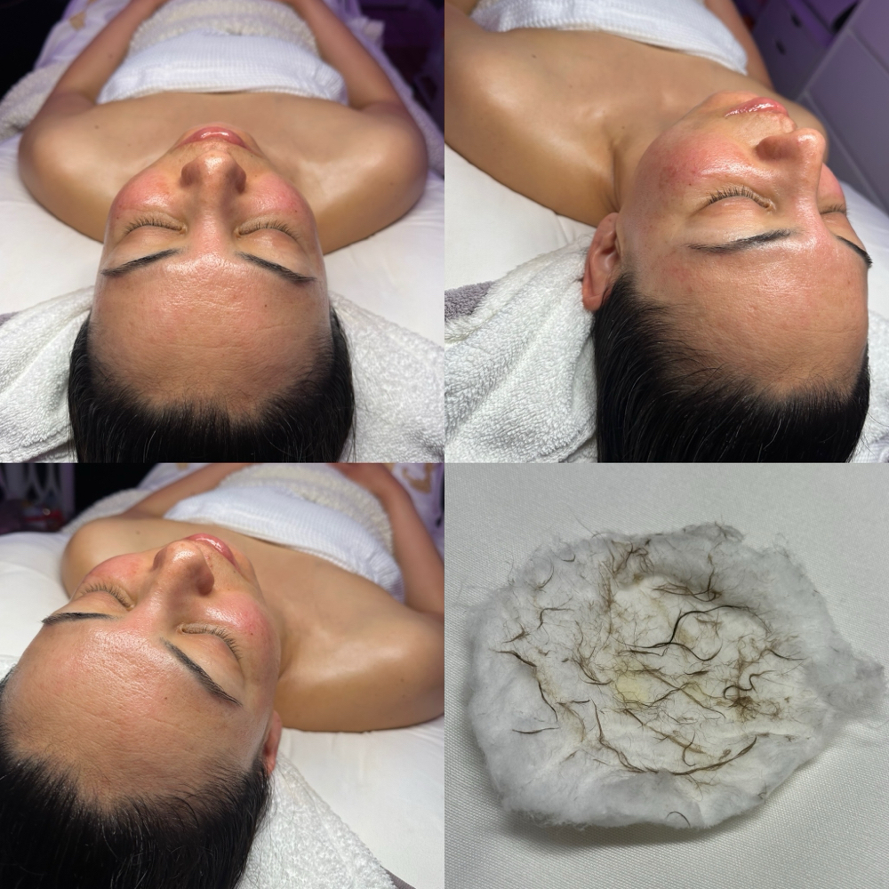 Dermaplaning Facial