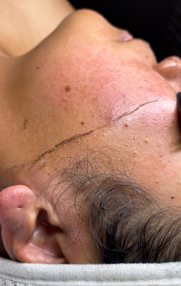 Dermaplane-ADD ON