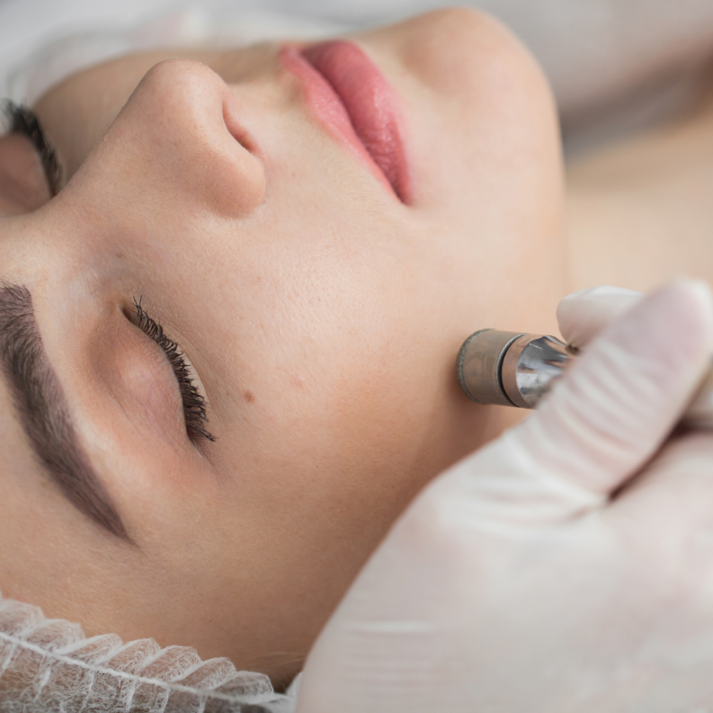 Microdermabrasion