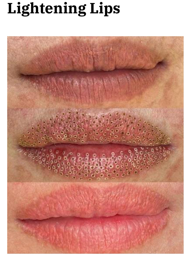 LIGHTENING LIPS- COLD PLASMA