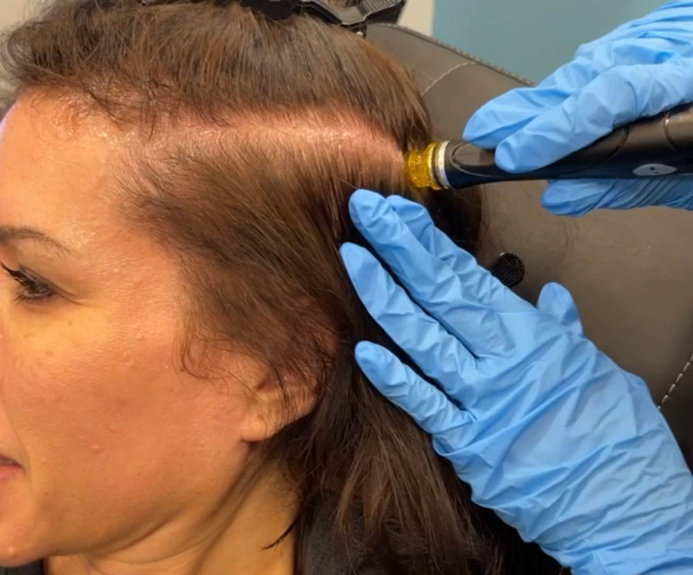 Keravive for Scalp