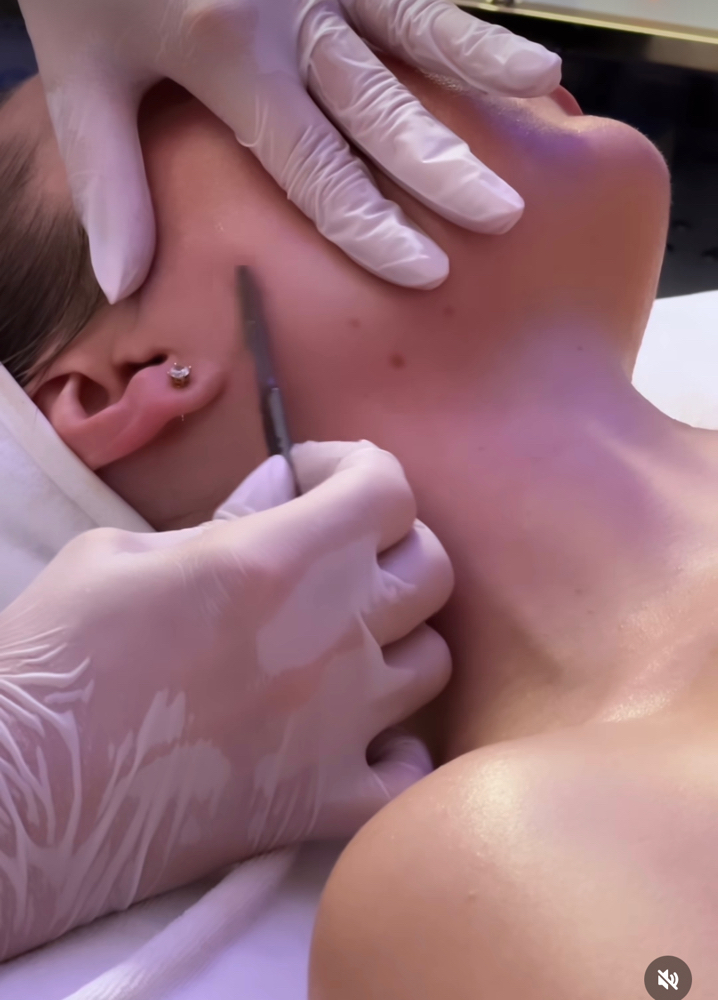 Add on:Dermaplaning