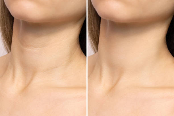 Smoothing Neck Treatment