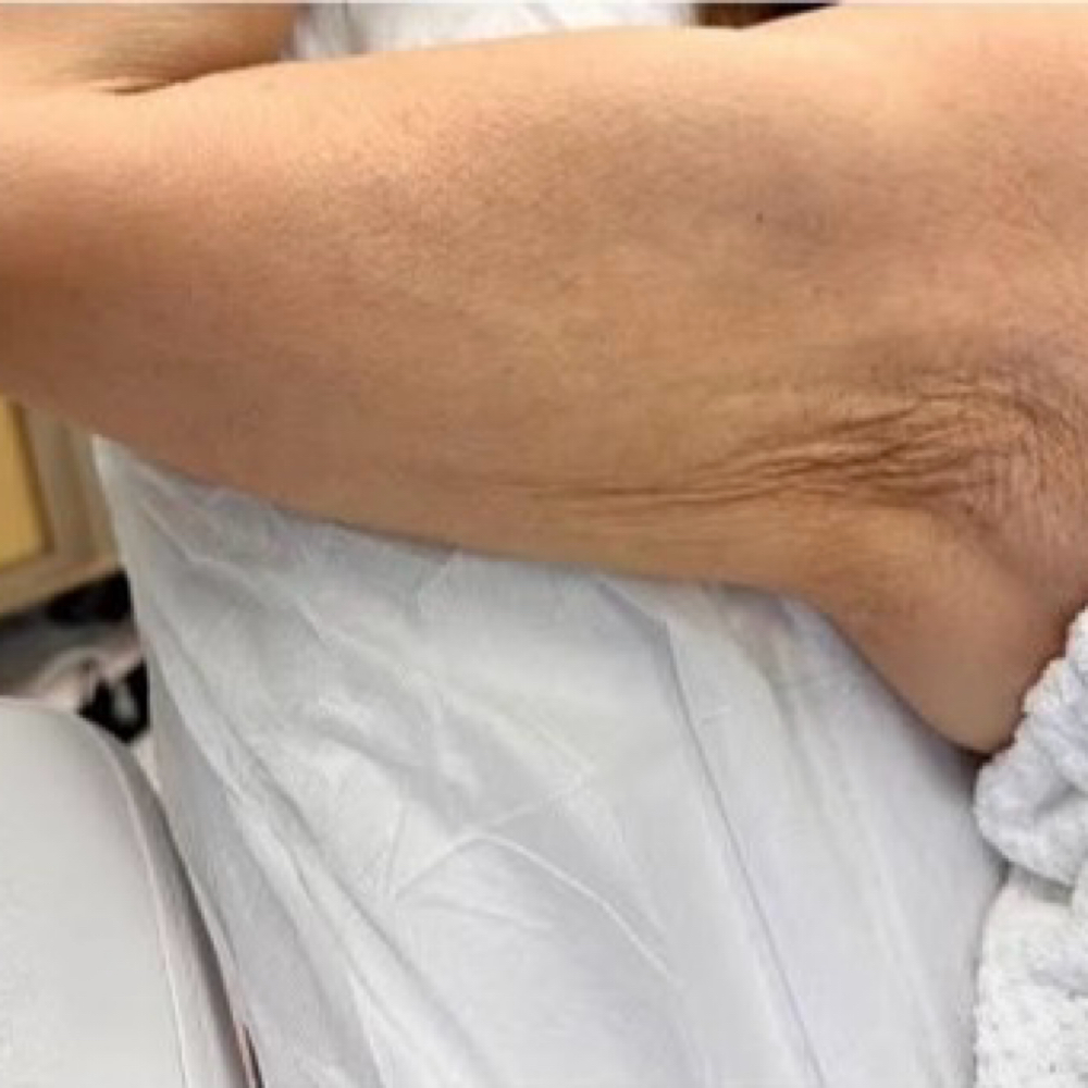 Tshape 2 Arms at KQ Aesthetics in Fort Worth, TX
