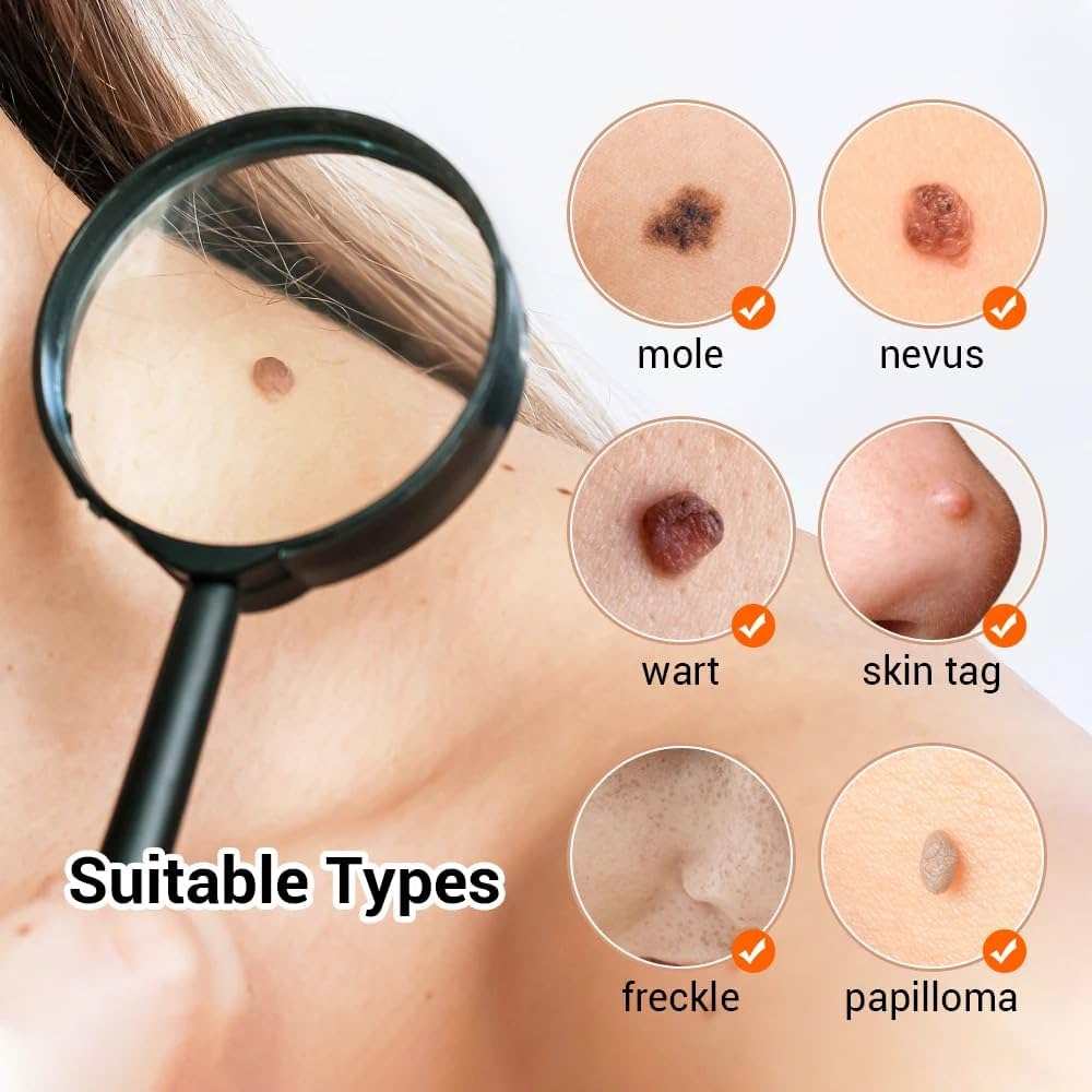 Fibroblast Warts at Leidy Cornelio Spa in Aurora, CO