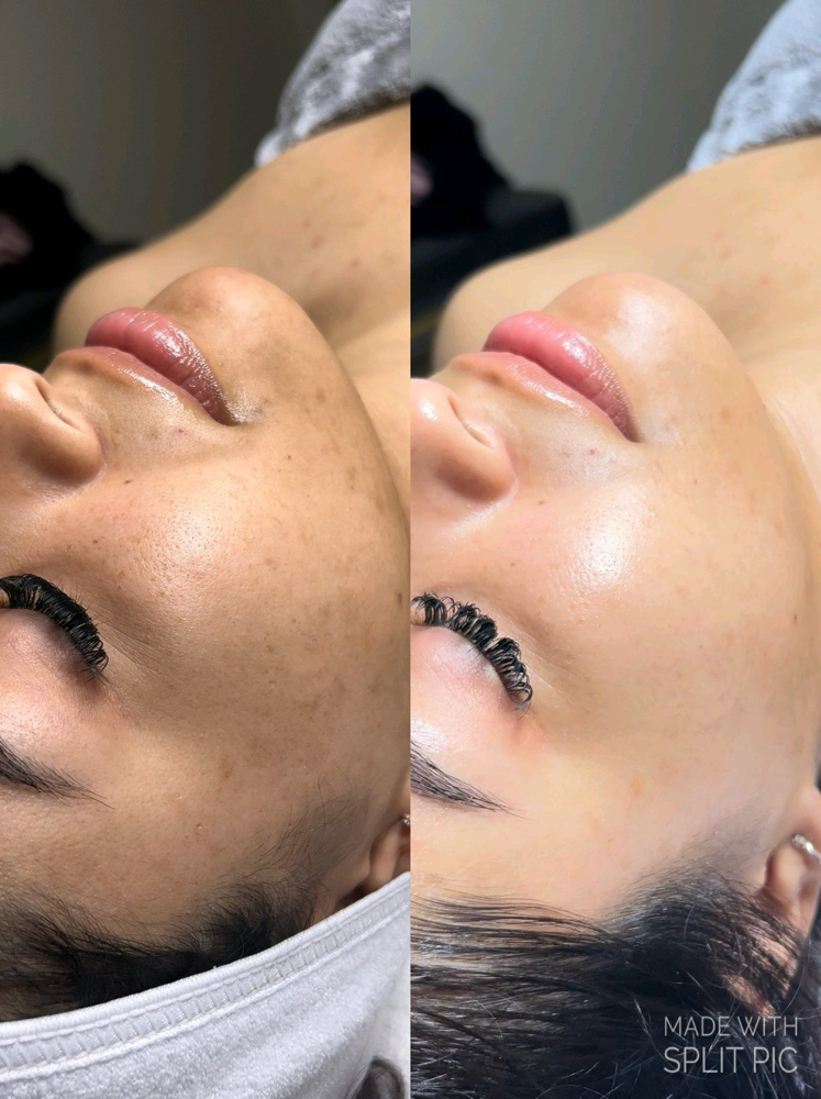 Signature Face Lift