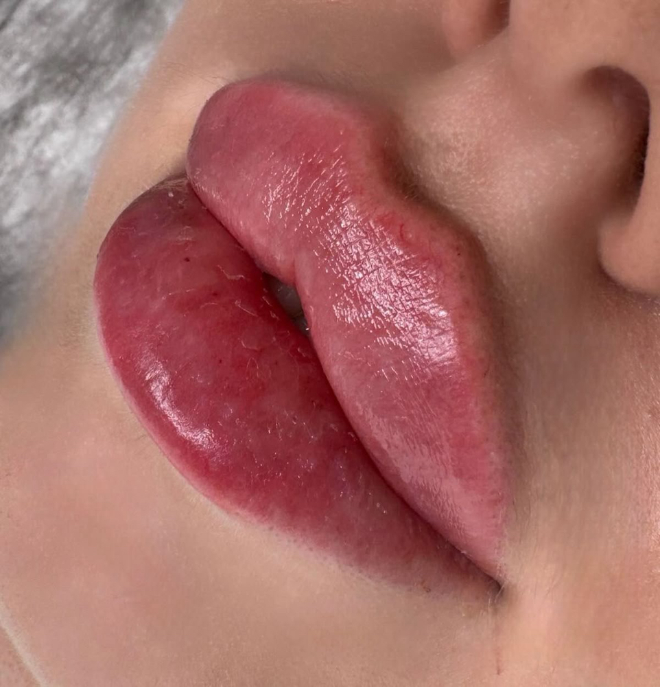 Russian lips 👄💉