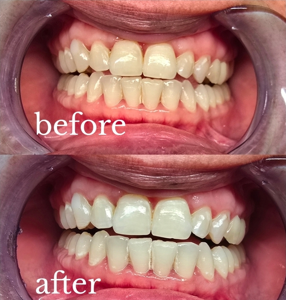 Teeth Whitening at Butterfly Beauty Bar in Winchester, VA