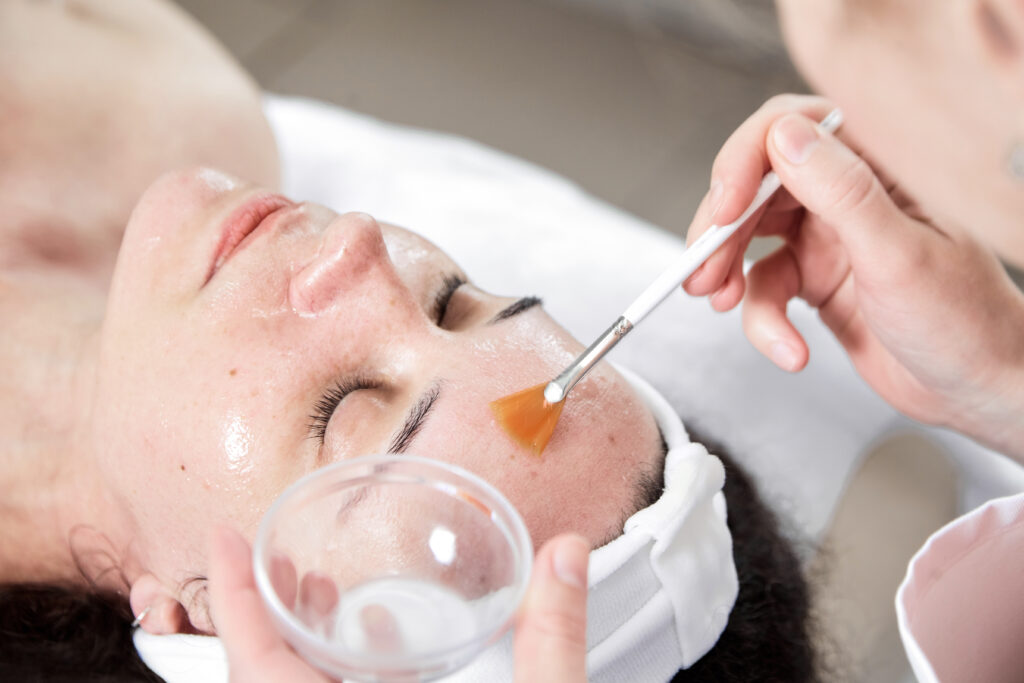 Chemical Peel