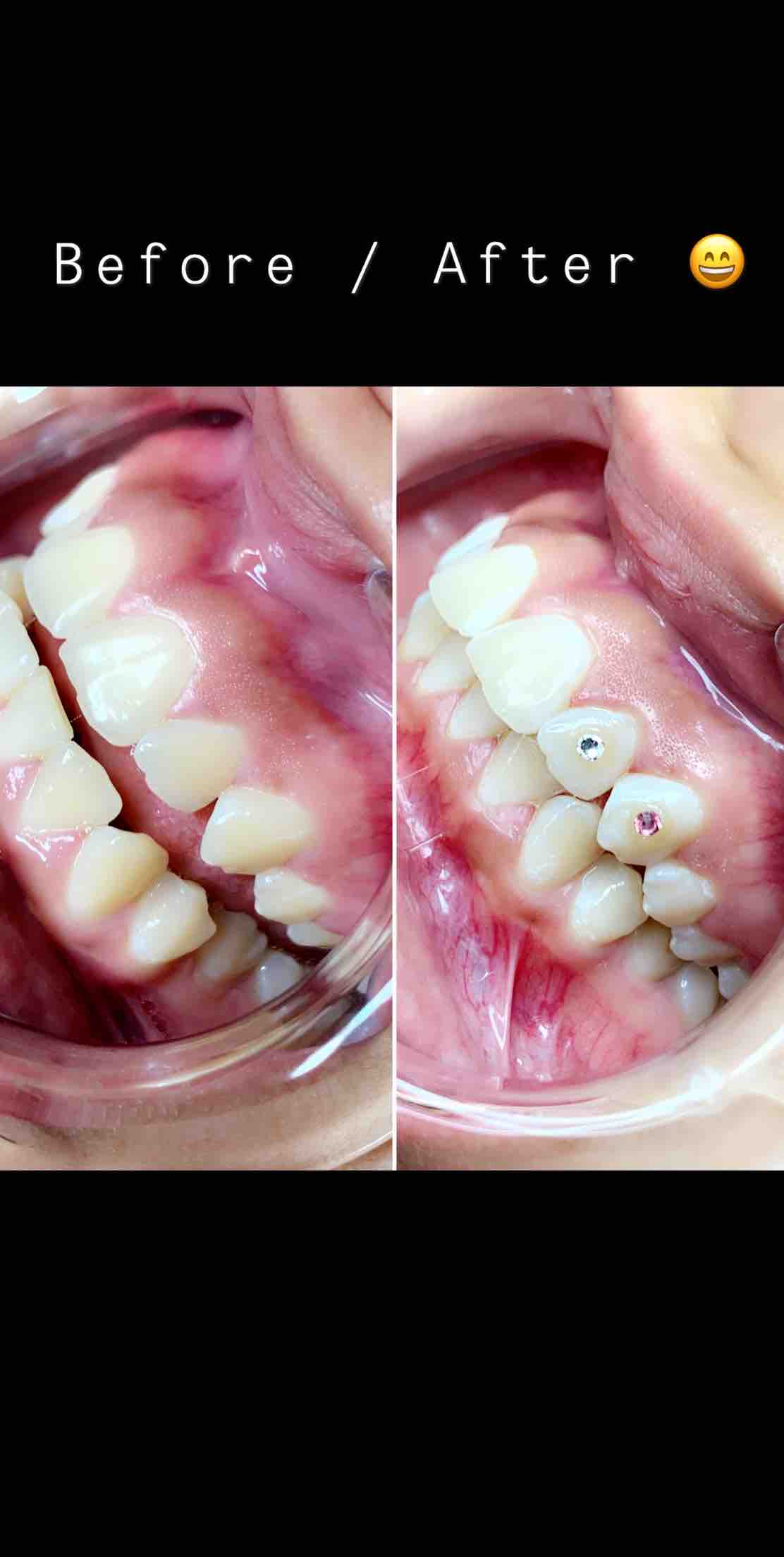 Tooth Gem 1 Tooth