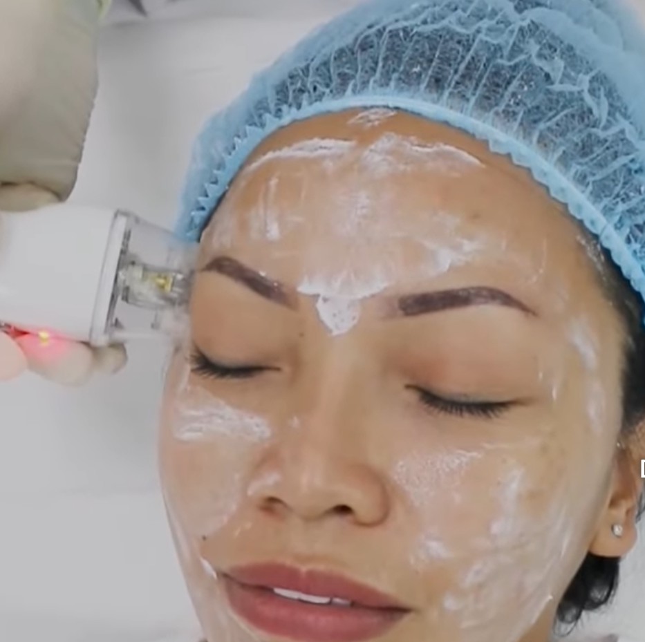 RF Fractional Skin Resurfacing